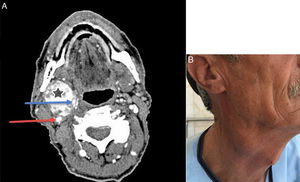 (A) A TC espiral do pescoço com contraste IV revela TCC (estrela), ACI (seta vermelha) e ACE (seta azul). (B) Homem, 60 anos, com lesão cervical direita indolor e não pulsátil presente havia 40 anos.