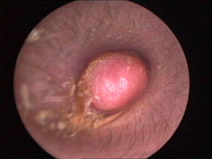 Endoscopia mostra um neoplasma rosado de forma ovalada com uma superfície lisa. A membrana timpânica estava coberta sem aderir à estrutura adjacente.