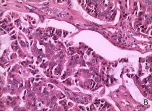 Núcleos vesiculares, citoplasma eosinofílico e fragmentos de alta densidade podem ser observados em algumas células (coloração hematoxilina‐eosina, ampliação de 200×).