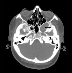 TC axial pré‐operatória. O estudo demonstra lesão de tecido mole com localização na fossa pterigopalatina que causa expansão do seio cavernoso esquerdo. O tumor empurra a parede posterior do seio maxilar em uma direção anterior e a parede lateral do seio esfenoide em uma direção medial (a seta indica o tumor).