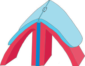 Esquema da aproximação das cartilagens laterais superiores (azul claro) sobre o septo (azul escuro). O mucopericôndrio é mostrado em vermelho.