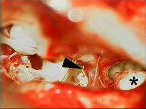 Fotografia do caso 5 com vista de timpanotomia posterior da orelha média. A seta aponta para a ponte fibrosa que liga o martelo à cabeça do estribo. Um colesteatoma residual é observado à direita (*).