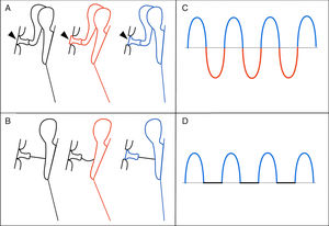 Desenho esquemático que demonstra o movimento da unidade tímpano‐ossicular em situação normal (A) e com ponte fibrosa (B). A cor preta representa a posição restante (neutra); a fase de compressão é representada em vermelho e a fase de rarefação, em azul. Note, em A, o comportamento normal do estribo na janela oval (pontas de setas), penetra no vestíbulo durante a compressão (vermelho) e sai dele durante a rarefação (azul). Em B, apenas a rarefação produz um movimento do estribo. À direita (C e D), a representação gráfica da onda da perilinfa resultante é detalhada. Note que, em D, apenas a fase de rarefação está presente.