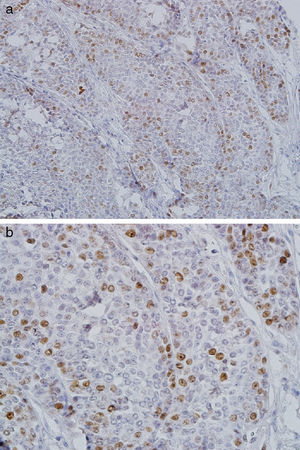 Expressão grave de CDC7 em células epidermoides de carcinoma mucoepidermoide de alto grau (A, × 200; B, × 400).