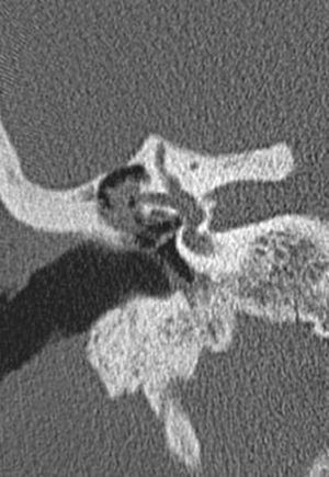 FL (canal semicircular lateral) em uma tomografia computadorizada (TC).