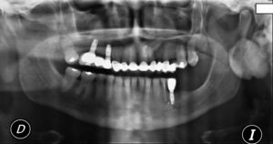 Vista da radiografia panorâmica que mostra uma lesão radiopaca localizada no centro do ramo ascendente da mandíbula esquerda.
