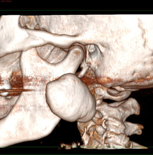 Imagem tridimensional que mostra uma lesão perfeitamente delimitada de aparência exofítica benigna na camada cortical externa do ramo ascendente da mandíbula.