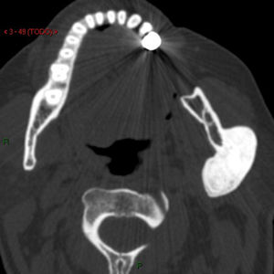 Tomografia computadorizada axial que mostra a lesão estendida para as superfícies interna e externa do ramo ascendente da mandíbula, sem causar reabsorção ou destruição óssea.