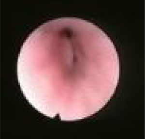Visão de fibra óptica do colapso do LV, colapso da parede lateral faríngea ao nível do palato mole.