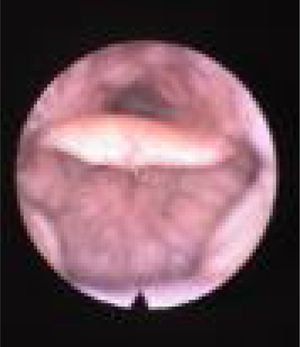 Visão de fibra óptica do colapso de TL, colapso da base baixa da língua que causa colapso epiglótico secundário.
