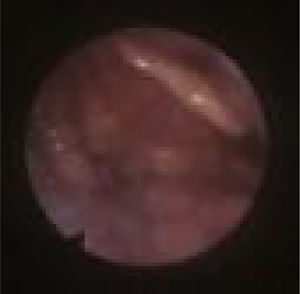 Visão de fibra óptica do colapso epiglótico (epiglote flácida).