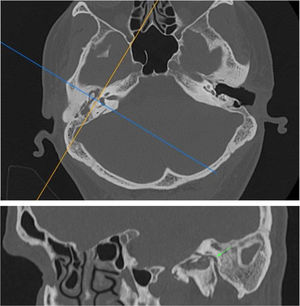 (A, B) As imagens com reconstrução sagital foram obtidas a partir de imagens obtidas por TCMD na projeção axial de corte fino. Os ângulos no segundo joelho, segmentos timpânico e mastoide do nervo facial (seta) estão demonstrados.
