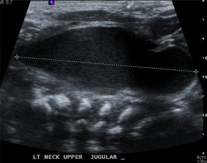 Na ecografia, a enorme massa cervical neonatal (4,0×2,3×1,5cm) foi descrita como massa cística com área anecoica.