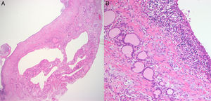 Achado histológico de cisto do corpo ultimobranquial na glândula tireoide (A, 100 ×). O cisto é revestido de epitélio escamoso estratificado, que é ligeiramente maior do que o das células foliculares da tireoide, com pequenos linfócitos circundantes (B, 400 ×).