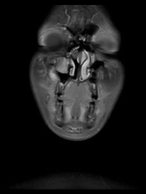 Ressonância magnética coronal dos seios maxilares revela uma massa no seio maxilar direito.