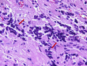 Células tumorais monótonas infiltram o estroma. As células têm núcleos redondos com pequenos e imperceptíveis nucléolos (setas). (Hematoxilina & eosina,×400).