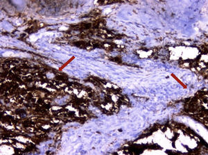 Células tumorais formam áreas sólidas e expressam sinaptofisina imuno‐histoquimicamente (setas) (200x). Legendas das figuras e setas corrigidas foram adicionadas às microfotografias.