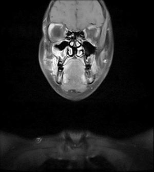 Ressonância magnética coronal dos seios maxilares; espessamento da mucosa aparece no seio maxilar direito, após o tratamento.