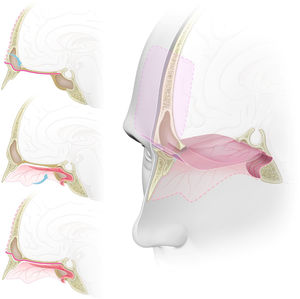 Representação gráfica da técnica de duplo retalho com os retalhos pericraniano e nasoseptal para reconstrução da base anterior do crânio. (A) vista sagital. O retalho pericraniano, após ser colhido com uma incisão bicoronal, é introduzido na cavidade nasossinusal através de uma “janela” na parede anterior do seio frontal, atinge o plano esfenoidal e a sela. (B) Vista sagital. Retalho nasoseptal retirado da parede medial da cavidade nasal, preserva seu pedículo vascular e colocado sobre o defeito da base anterior do crânio. (C) Vista sagital. Os retalhos pericraniano e nasoseptal se sobrepõem e reforçam os pontos fracos um do outro para a reconstrução da base anterior do crânio, reduzem o risco de fístula liquórica ou herniação cerebral. (D) Vista tridimensional com uma secção sagital da linha média. Defeito na base do crânio da parede posterior do seio frontal para o plano esfenoidal, reconstituído pela técnica endoscópica de duplo retalho com os retalhos pericraniano e nasoseptal reforçando‐se mutuamente, melhora o suporte mecânico das estruturas intracranianas e uma barreira mais efetiva à fístula liquórica.
