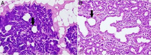 (A) Dilatação no lúmen dos dutos intercalados nas células acinares da glândula parótida do grupo de excisão unilateral da glândula submandibular (200×, microscópio óptico; H&E). (B) Dilatação no lúmen dos dutos intercalados nas células acinares da glândula parótida do grupo de excisão bilateral da glândula submandibular (200×, microscópio óptico; H&E). ↓, Lúmen do duto intercalado.
