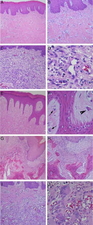 Coloração com hematoxilina e eosina. (A) Hiperplasia fibrosa inflamatória (40×); (B) Maior aumento do mesmo caso mostrando densos feixes de fibras colágenas (100×); (C) Granuloma piogênico oral (100 x); (D) Maior aumento do mesmo caso mostrando grande quantidade de células endoteliais e vasos sanguíneos neoformados (400×); (E) Fibroma de células gigantes, com projeções epiteliais finas e longas (100×); (F) Maior aumento do mesmo caso mostrando a presença de fibroblastos com morfologia estrelada (seta) e multinucleados (cabeça de seta) (400×); (G) Fibroma ossificante periférico, com produto mineralizado no tecido conjuntivo (40×); (H) Maior aumento do mesmo caso demonstrando formação de trabéculas ósseas irregulares (100×); (I) Lesões de células gigantes periféricas (100×); (J) Maior aumento do mesmo caso com grande quantidade de células gigantes multinucleadas associadas a áreas hemorrágicas (400×).