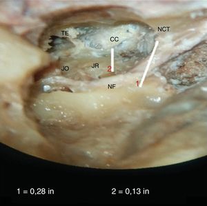 Fotografia mostra a medida da distância mínima entre a janela redonda, JR e o canal carotídeo, CC. NF, nervo facial; JO, janela oval; TE, abertura da tuba de Eustáquio; NCT, nervo da corda do tímpano. A linha 1 é para calibração.