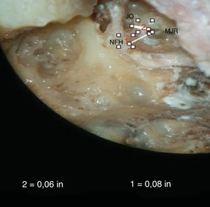 Fotografia mostra a medida da distância mínima entre a membrana de janela redonda (MJR) e o nervo facial horizontal (NFH) e a MJR e a janela oval (JO).