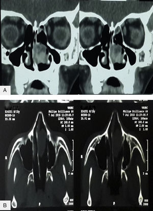Avaliação pré‐operatória por tomografia computadorizada coronal (A) e (B) axial, mostra uma lesão com densidade de tecido mole na fossa nasal esquerda, com realce heterogêneo pós‐contraste.