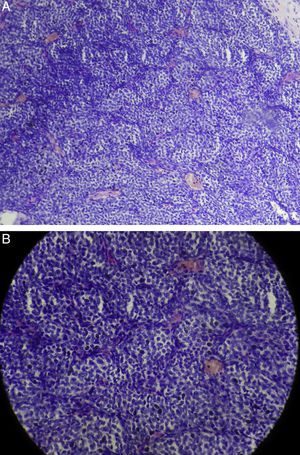 Imagens da análise histopatológica mostra padrão patognomônico zellballen clássico de paraganglioma. (A), Baixa magnificação; (B), Alta magnificação.