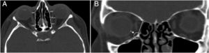 (A) Imagem axial identifica a localização do forame etmoidal anterior (FEA) e forame etmoidal posterior (FEP) e mostra a medida do comprimento da lâmina papirácea (LPcomp); (B) Imagem coronal mostra a altura da lâmina papirácea anterior (LPalt) do forame etmoidal anterior até a sutura etmoidal‐maxilar (SEM) e o ângulo inferomedial anterior (seta) entre as paredes medial e inferior da órbita.
