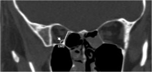 Imagem coronal mostra a altura da lâmina papirácea posterior (LPalt) do forame etmoidal posterior à sutura etmoidal‐maxilar (SEM) e o ângulo inferomedial posterior (seta) entre as paredes medial e inferior da órbita.