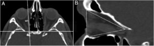 (A) Imagem axial mostra a identificação do forame orbital (FO) e do músculo reto medial (RM). (B) Medida da área da parede medial no plano sagital da posição axial.