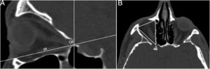 (A) Imagem sagital mostra a identificação do forame orbital (FO) e do músculo reto inferior (RI). (B) Medida da área do assoalho orbital no plano axial da posição sagital.