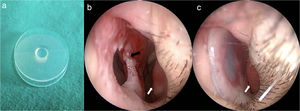 Botão septal (a), perfuração septal (b), paciente com botão septal (c). Setas brancas, concha inferior; Seta Negra, perfuração septal.
