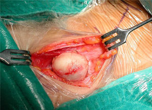 Vista intraoperatória do cisto e dissecção cirúrgica em seu redor.