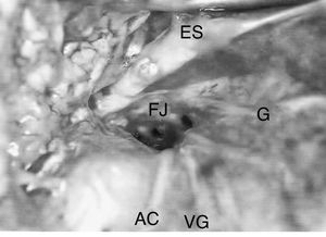 Forame jugular (FJ) direito após remoção da veia jugular interna, nervo acessório (AC), nervo glossofaríngeo (G), nervo vago (VG), processo estiloide (ES).