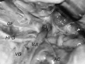 Nervo acessório (AC) esquerdo cruza posteriormente a veia jugular interna (VJI). FJ, forame jugular; GF, nervo glossofaríngeo; HPG, nervo hipoglosso; VG, nervo vago.