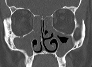 Tomografia pré‐operatória dos seios paranasais com corte coronal de um caso do Grupo 2.