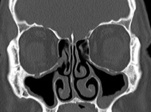 Lado direito do caso da Figura 1, tomografia feita um ano após a sinuplastia com balão nos seios nasais direitos e FESS clássica nos seios esquerdos.