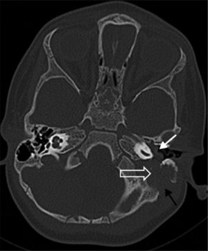 Imagem de tomografia computadorizada axial na janela óssea mostra lesão (seta aberta) nas células aéreas mastoideas, com extensão para a cavidade da orelha média (seta branca). Observe a erosão cortical associada no osso mastoideo (seta preta).