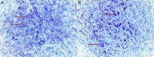(A) Setas mostram células tumorais que foram positivamente coradas com CD1a (CD1a, ×400); (B) Setas mostram células tumorais que foram positivamente coradas com S100 (S100, ×400).