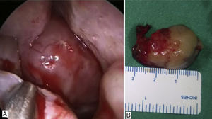 A, Lesão tumoral com sangramento na cavidade nasal; B, Lesão após excisão endoscópica.