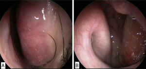 A, Corneto inferior aumentado na cavidade nasal esquerda; B, Massa que avança para a orofaringe a partir da cavidade nasal esquerda.