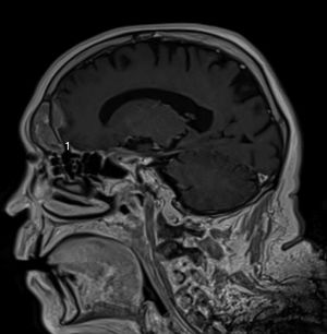 Extensão de metástase do seio frontal com perda da zona óssea hipointensa mostra invasão dural (RM, T1).