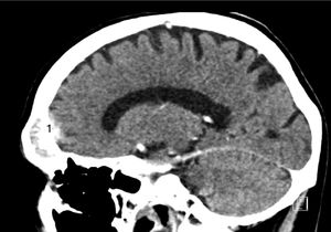 Imagens de TC mostram lesão frontal grande com penetração óssea (1).