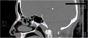 Projeção sagital reformatada da tomografia computadorizada da cavidade nasal. A linha amarela indica o eixo acústico estimado e o fluxo de ar nasal fisiológico.