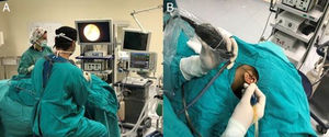 (A) A localização na sala de cirurgia: o monitor está ao nível dos olhos do cirurgião e a enfermeira no lado oposto, (B) o endoscópio está na mão esquerda e o instrumento cirúrgico na mão direita.