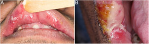 Sífilis oral representada por úlceras e placas mucosas múltiplas (A) e única (B).