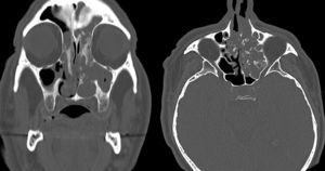 Tumor ósseo multifocal bilateral com lesões de tecido mole em imagens de TC axial e coronal.