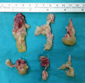 Tecidos patológicos removidos na cirurgia. Eles incluem massa óssea separada anexada a tecidos de papiloma invertido.